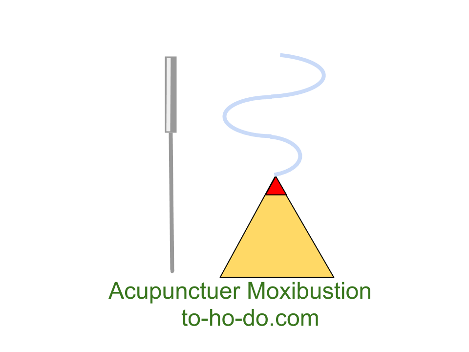 はりきゅうacupunctuer